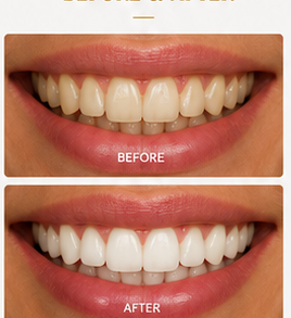 Example before and after teeth whitening result